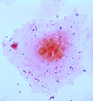 Streptococcus bacteria (small purple spheres) attacking human cells (nucleus in dark red)