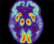 PET scan of a human brain with Alzheimer's disease