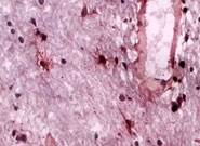 An MS lesion within human brain tissue, revealing numerous galanin-positive cells (black dots).