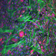 Prostate cancer cells (PC-3, blue and pink) invading through a 3D collagen matrix containing non-cancerous fibroblasts (green). The cancer cells interact intimately with the fibroblasts, which in turn stretch and pull on the matrix to create archways that the cancer cells invade through.