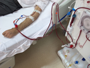 Generic image of a patient undergoing dialysis treatment