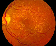 A fundus photo showing intermediate age-related macular degeneration