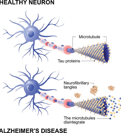 Alzheimer's disease is the change in tau protein that results in the breakdown of microtubules in brain cells. Mechanism of disease. Diagram shows two neurons: healthy cell and neuron with Alzheimer's disease. Tau hypothesis. Neurofibrillary tangles