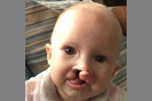 Elsie before surgery when she was seven months old