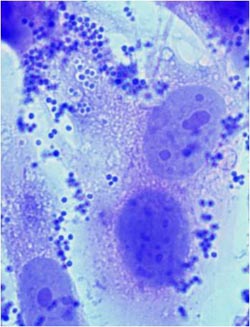 Staphylococcus aureus attached to human osteoclasts (bone cells)