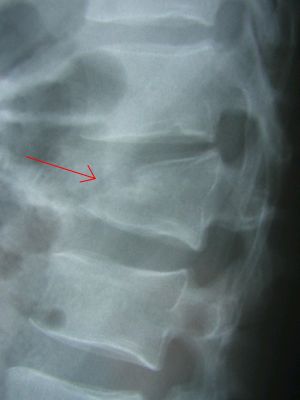 Vertebral osteoporotic fracture can lead to wedge deformity (arrow)