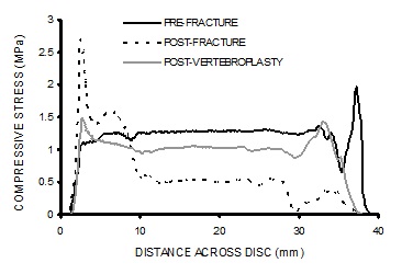 Stress profiles show a marked loss of pressure in the central region (nucleus pulposus) of the intervertebral disc following fracture that is associated with concentrations of compressive stress in the periphery of the disc (annulus).