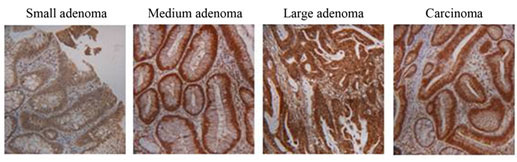 Image of colorectal adenomas and carcinomas