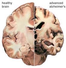 diagram of a brain affected by altzeheimers