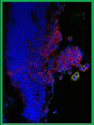 Micrograph of immune cells infiltrating the eye