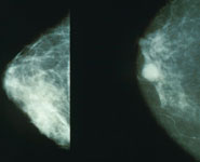 Normal (left) versus cancerous (right) mammography image.