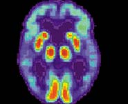 A PET scan of a human brain with Alzheimer's disease