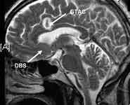 Sagittal MRI scan of the brain showing the position of one of the deep brain stimulation (DBS) leads and one of the guide tubes for anterior cingulotomy (GTAC). Scan taken during surgery. [A]= front of brain