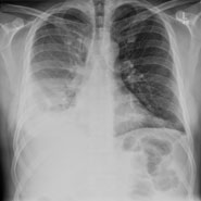 Chest X-ray image before treatment