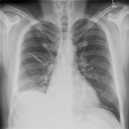 Chest X-ray image after treatment