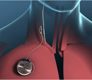 An image of the device (implanted on the right side of the chest)
