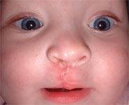 A six-month-old girl after surgery to have her unilateral complete cleft lip repaired
