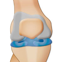 Diagram of the knee joint showing the meniscal cartilage