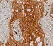 A section from a colon carcinoma stained for fascin-1.