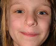 An eight-year-old girl showing a scar from infantile facial reconstruction surgery