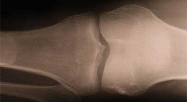 Close-up view of human knee x-ray