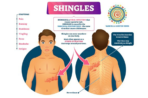Infographic about shingles and symptoms