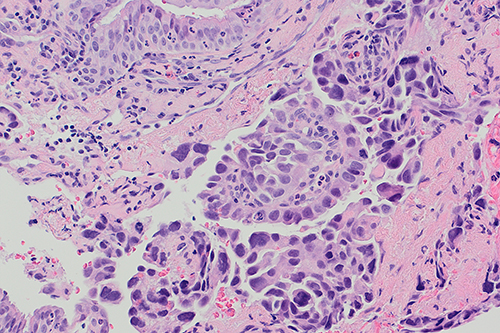 Non-small cell lung cancer (NSCLC) invading bronchial epithelium