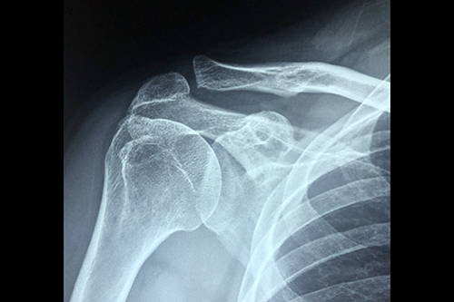 A shoulder x-ray