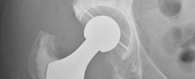 An xray of a hip replacement joint