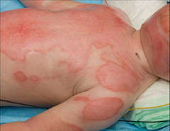 Child's skin's protective barrier is lost following a burn injury