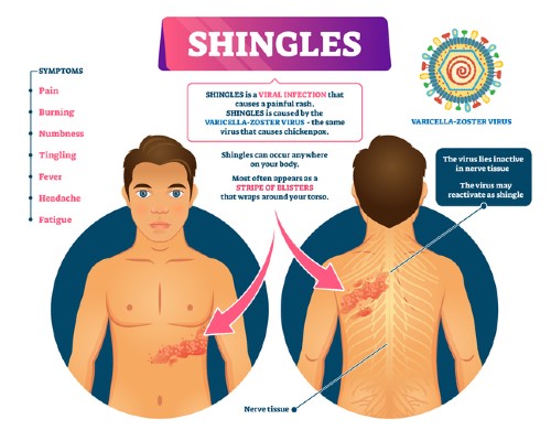 2022: Preventing long-term pain from shingles | Centre for Academic Primary  Care | University of Bristol